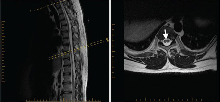 27-year-old male presented with chronic low back pain for a year and half after he sustained minor back trauma at work. Pain was radiating to both lower extremities, but more to the right side. It was later diagnosed as a form of spinal cord malformation. a) Sagittal T2W and b) axial T2W MRI of the thoracic spine show split cord (arrowhead) starting at the level of T7–T8 spine segment and continuing down to the level of T12 where the two hemicords then fused back into normal conus medullaris.