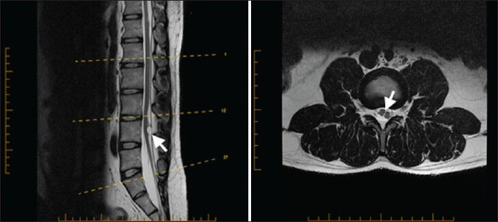 27-year-old male presented with chronic low back pain for a year and half after he sustained minor back trauma at work. Pain was radiating to both lower extremities, but more to the right side. It was later diagnosed as a form of spinal cord malformation. a) Sagittal T2W and b) axial T2W MRI of the lumbar spine show a low-lying conus medullaris that once again split into two hemicords (arrowhead in b) at the L3–L4 level, with a low-lying tethered cord inserted posteriorly at S1. Notice in the sagittal T2W MRI the presence of intradural hyperintense circular lesion and hyperintense lesion in T1W (not shown) characteristic for lipoma (arrowhead in a).