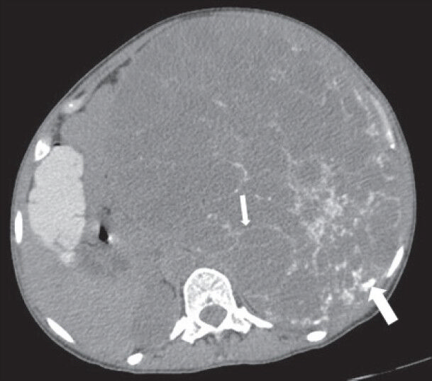 40-year-old female with abdominal mass subsequently diagnosed as extragastrointestinal stromal tumor (EGIST) in the retroperitoneum. Nonenhanced computed tomography of abdomen (axial section) shows a large well-defined lesion with low attenuation areas and reticular pattern fine linear calcification (small arrow) involving the abdominal cavity, predominantly on the left side. Few rounded foci of calcification are also noted in the posterior part of the lesion (thick white arrow).