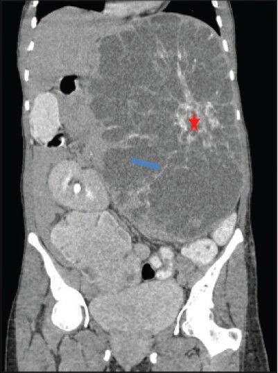 40-year-old female with abdominal mass subsequently diagnosed as EGIST in the retroperitoneum. Contrast-enhanced computed tomography (CECT) of abdomen (coronal section) during venous phase demonstrates multiple enhancing septae (blue arrow) radiating out from a central enhancing soft tissue attenuation structure (red asterisk). No enhancement of the low attenuation areas is noted.