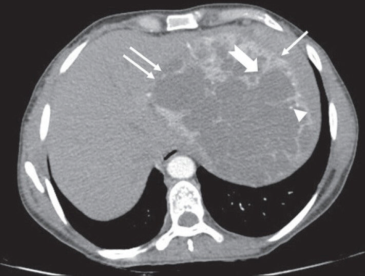 40-year-old female with abdominal mass subsequently diagnosed as EGIST in the retroperitoneum. CECT abdomen (axial section) during venous phase shows the lesion compressing spleen (solid arrow), left lobe of liver (solid double arrows) without invasion (negative embedded organ sign). Few septae in the periphery appear thicker (notched arrow). Few tiny foci of calcification are also noted in the periphery (arrowhead)