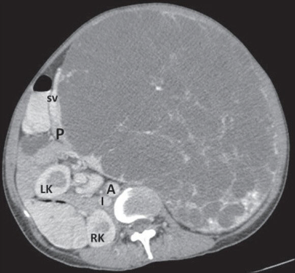 40-year-old female with abdominal mass subsequently diagnosed as EGIST in retroperitoneum. CECT abdomen (axial section) during venous phase shows the lesion compressing head and body of pancreas (P) without infiltration (negative embedded organ sign) and a distinct intervening fat plane with abdominal aorta (A). LK: Left kidney, RK: Right kidney, I: Inferior vena cava, SV: Splenic vein.