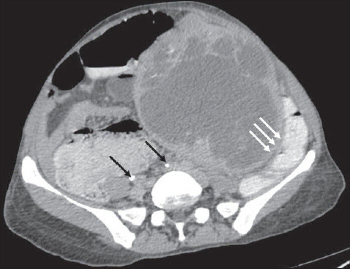 40-year-old female with abdominal mass subsequently diagnosed as EGIST in retroperitoneum. CECT abdomen (axial section) in excretory phase demonstrates contrast excretion with adequate opacification of ureters (thin black arrows). The mass lesion shows negative embedded organ sign with descending colon (solid triple white arrows).