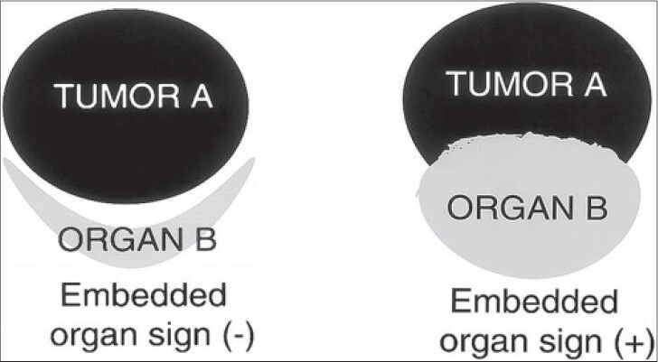 Embedded organ sign, schematic diagram (reproduced with permission from Ref. [4). Schematic diagram shows embedded organ sign, negative and positive.