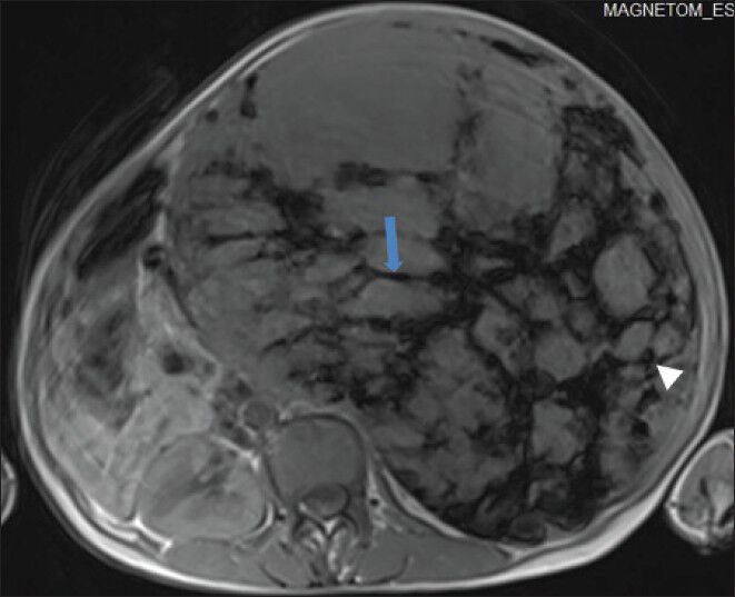 40-year-old female with abdominal mass subsequently diagnosed as EGIST in retroperitoneum. Non-enhanced magnetic resonance imaging (MRI) (axial section) of abdomen shows the mass with low signal intensity areas, multiple markedly hypointense linear bands (blue arrow) in a reticular pattern, and few hypointense round foci (white arrowhead) on T1-weighted spin echo (SE) images.