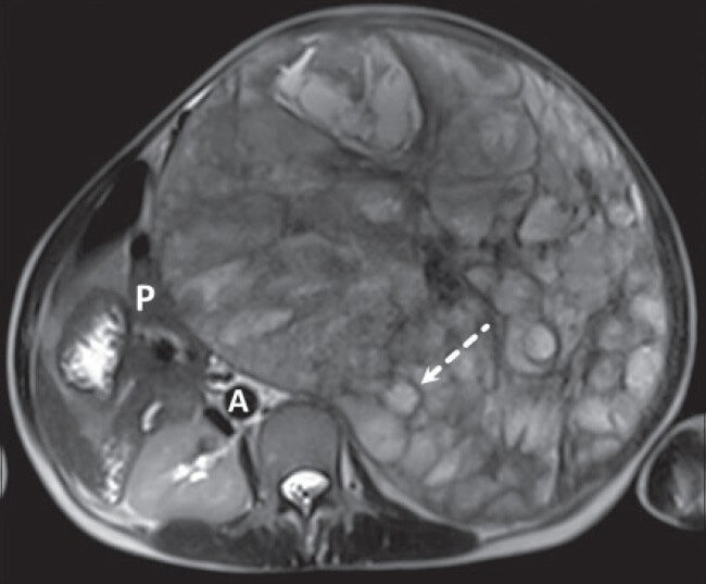 40-year-old female with abdominal mass subsequently diagnosed as EGIST in retroperitoneum. MRI (axial section) of abdomen shows multiple loculated structures with iso- to mildly hyperintense signal intensity on T2-weighted fast spin echo (FSE) image (dashed arrow) [pancreas (P), aorta (A)].