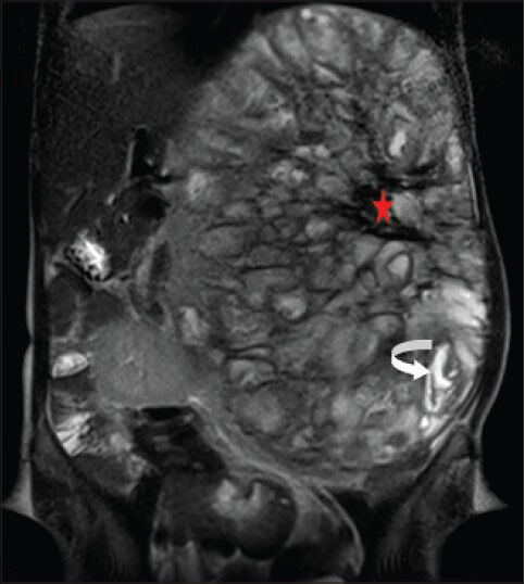 40-year-old female with abdominal mass subsequently diagnosed as EGIST in retroperitoneum. MRI (coronal section) of abdomen shows a few of the loculated structures with bright fluid signal intensity (curved white arrow) and the central region of the lesion with large hypointense signal (red asterisk) on T2-weighted FSE images.