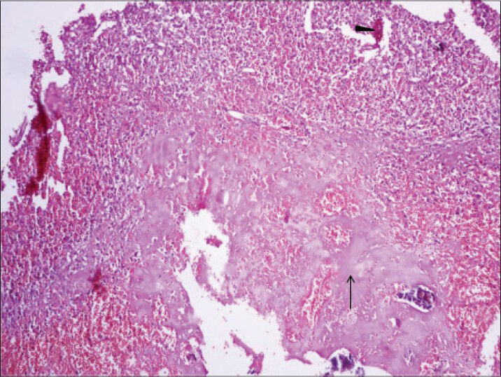 40-year-old female with abdominal mass subsequently diagnosed as EGIST in retroperitoneum. Photomicrograph [hematoxylin and eosin (H and E) stained sample (×10)] shows extensive hyalinization, scanty cellular areas with few areas of hemorrhage (black arrowhead), and foci of osseous metaplasia (thin long black arrow).