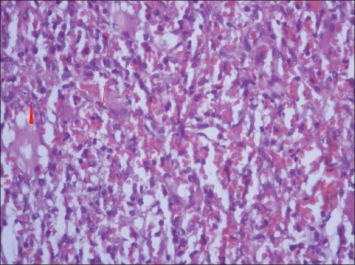 40-year-old female with abdominal mass subsequently diagnosed as EGIST in retroperitoneum. Photomicrograph of hematoxylin and eosin (H and E) stained sample (×40) shows fascicles of uniform bland spindle cells (thin long red arrow) with pale eosinophilic fibrillary cytoplasm and extravasated red blood cells. Perinuclear vacuoles indent the nucleus (red arrowhead).