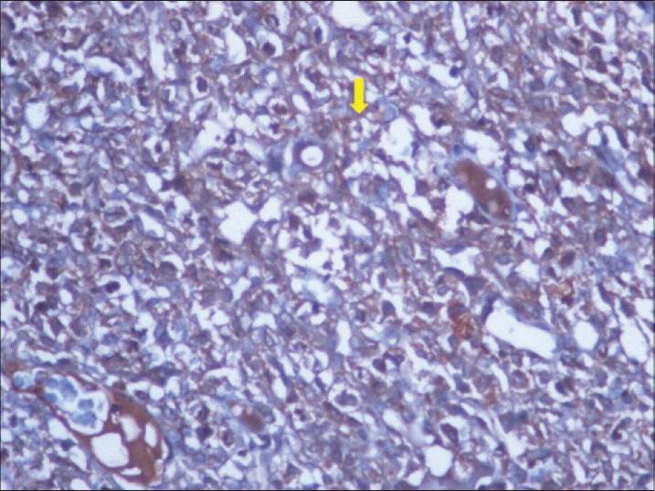 40-year-old female with abdominal mass subsequently diagnosed as EGIST in retroperitoneum. Immunohistochemical staining for CD117 (C-KIT) (×40) shows diffuse reactivity for tumor cells (thick yellow arrow).