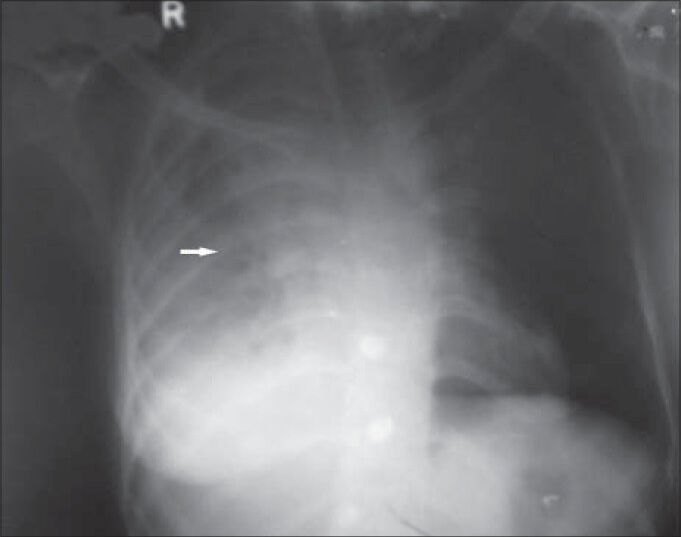 26-year-old female with chest pain and breathlessness diagnosed with pleural and peritoneal mesothelioma. Chest X-ray poster anterior view reveals opaque right hemithorax with areas of radiolucencies in the right mid zone (horizontal arrow). Right costophrenic angle and right hemi diaphragm silhouette is obliterated by soft-tissue opacity. There is no evidence of any calcification or bone destruction. Right side shows mild tracheal and mediastinal shift. Left lung field and costophrenic angle on the left side are clear.