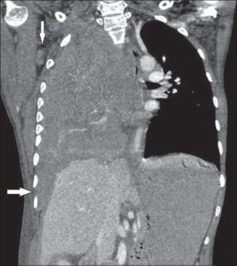 26-year-old female with chest pain and breathlessness diagnosed with pleural and peritoneal mesothelioma. Post-contrast CT coronal view shows contiguous rind-like soft-tissue attenuation pleural mass lesion encasing right hemithorax and scalloping of liver (horizontal arrow). Right side shows axillary lymphadenopathy (vertical arrow).