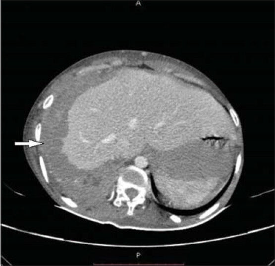 26 year-old female with chest pain and breathlessness diagnosed with pleural and peritoneal mesothelioma. Post-contrast CT scan axial view shows pleural-based mass lesion (horizontal arrow) causing scalloping of the liver parenchyma with loss of extra pleural fat planes along the right lateral chest wall. No rib destruction is noted.