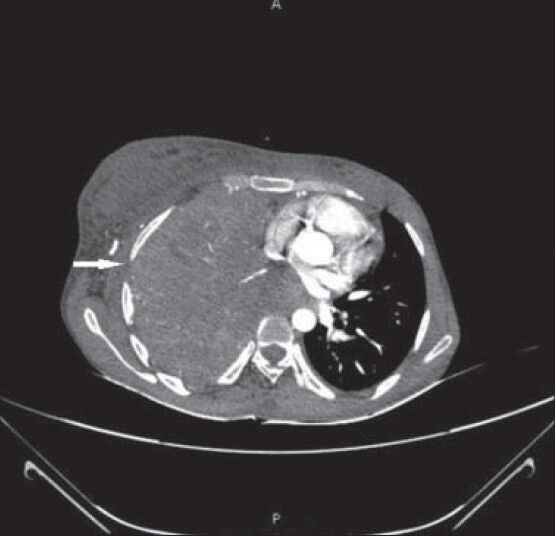 26-year-old female with chest pain and breathlessness diagnosed with pleural and peritoneal mesothelioma. Post-contrast CT scan axial view shows soft-tissue attenuation pleural mass lesion completely encasing the right lung which shows consolidation collapse. Right lateral chest wall shows loss of extra pleural fat plane (horizontal arrow). However, no definite invasion of intercostal muscles is seen.