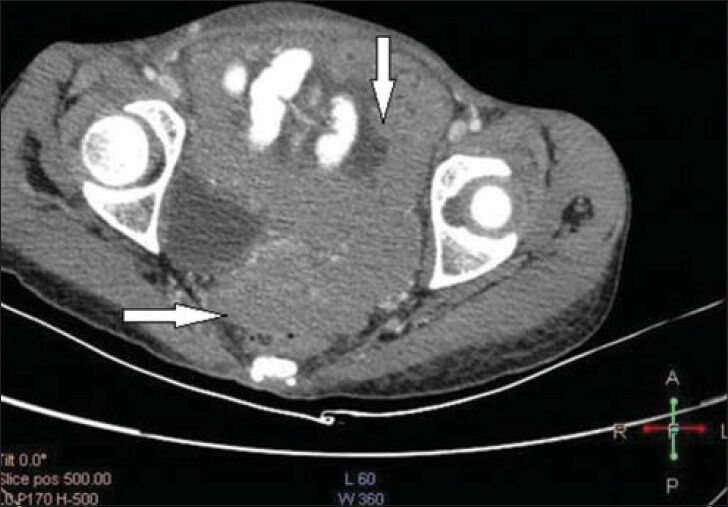 26-year-old female with chest pain and breathlessness diagnosed with pleural and peritoneal mesothelioma. Post-contrast axial CT sections from the pelvis show homogenously enhancing soft-tissue attenuation mass lesion (horizontal and vertical arrows) in the pelvis, abutting the small and large bowel loops without causing any obstruction. Ascites is also noted.