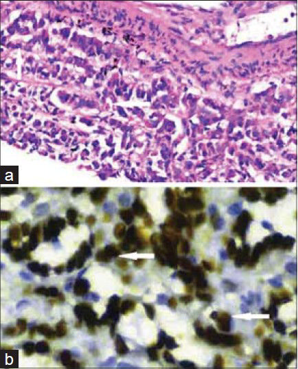 26-year-old female with chest pain and breathlessness diagnosed with pleural and peritoneal mesothelioma. (a) Histopathology slide of the biopsy specimen. Hematoxylin and eosin staining of the lung biopsy sample (×400) shows malignant epithelial cells in acinar pattern (vertical arrow) infiltrating the lung tissue in a linear fashion (horizontal arrow). (b) Biopsy sample stained for Wilms’ tumor protein shows nuclei positive (horizontal arrows) for the protein (×1000), which confirms the diagnosis of mesothelioma.