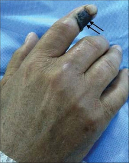 74-year-old presented with dry gangrene of the right index finger. Photo of the patient's right hand shows dry gangrene of the index finger (arrows).