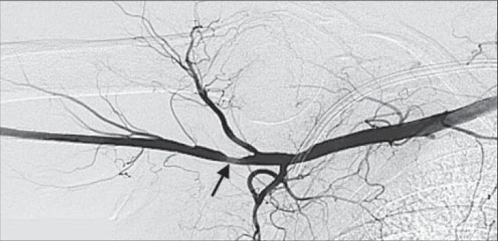 74-year-old presented with dry gangrene of the right index finger. Digital subtraction angiography (DSA) of the right axillary artery shows focal moderate stenosis (arrow).