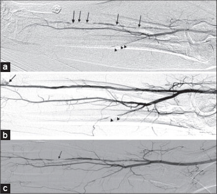 74-year-old presented with dry gangrene of the right index finger. a) DSA of the right radial artery shows a long segment of multifocal stenosis/ occlusion (arrows) and occlusion of the ulnar artery. b) Post percutaneous transluminal angioplasty (PTA) DSA shows marked improvement of flow within the radial artery. Minimal extravasation is seen at the radial puncture site (arrow), which was readily controlled by manual pressure. Proximal occlusion of the ulnar artery is seen (arrowheads). c) Two-month follow-up DSA shows recurrence of a short segment of high-grade stenosis at the level of the previously recanalized occluded vessel (arrow).