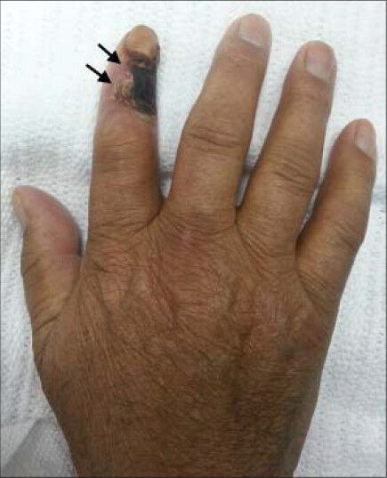 74-year-old presented with dry gangrene of the right index finger. Photo of the patient's right hand at 4-week follow-up shows partial healing of the gangrene (arrows).