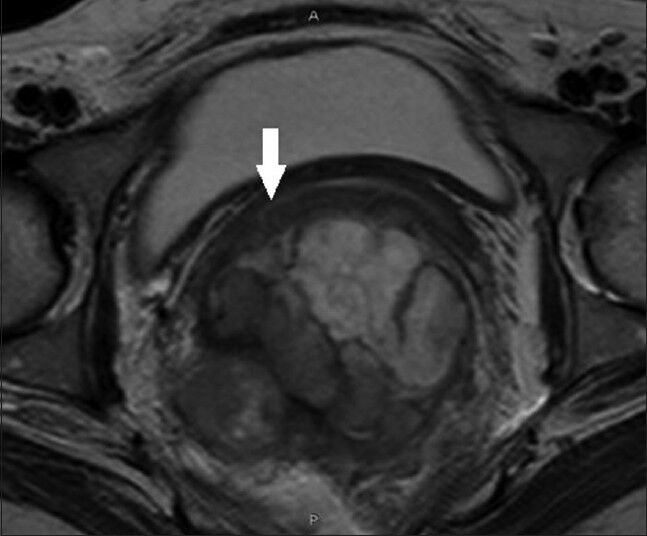 43-year-old woman with protruding anal lesion diagnosed with melanoma of the rectum. T2- weighted axial MR images of pelvis show irregular lobulated mass of rectum with intra- and extra-mural extension with involvement of posterolateral wall of vagina (white solid arrow).
