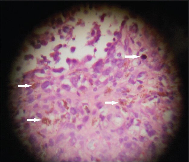 43-year-old woman with protruding anal lesion diagnosed with melanoma of the rectum. Histopathological biopsy sample stained with hematoxylin and eosin (× 100) shows pleomorphic lesions with melanin pigment (white solid arrows) suggestive of malignant melanoma.