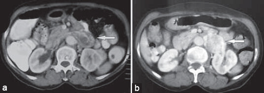 61-year-old hypertensive post-menopausal woman presented with a 2-year history of dull aching intermittent left hypochondrial pain that occasionally radiated to her back with paroxysmal attacks of palpitations and sweating, which was subsequently diagnosed as renal vein leiomyoma. a) Contrast-enhanced computed tomography (CECT) scan shows well-defined, lobulated, heterogeneously enhancing retroperitoneal mass of size 3.6 × 3.5 cm in the left para-aortic location, with the left renal vein being invaded by the tumor (arrow). b) Positron emission tomography computed tomography (PET CT) scan shows moderate fluorodeoxy glucose (FDG) uptake (SUV 4.7) in the tumor (arrow).