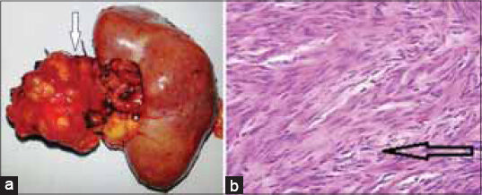 61-year-old hypertensive post-menopausal woman presented with a 2-year history of dull aching intermittent left hypochondrial pain that occasionally radiated to her back with paroxysmal attacks of palpitations and sweating, which was subsequently diagnosed as renal vein leiomyoma. a) Gross specimen shows the en bloc resected specimen with well-defined, lobulated tumor in relation to the left renal hilum. b) Histopathology slide with hematoxylin and eosin staining shows smooth muscle bundles separated by well-vascularized connective tissue with no atypia, suggestive of leiomyoma (arrow).