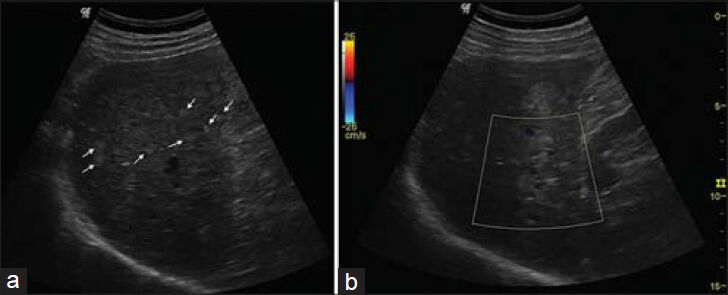 68-year-old male referred to our hospital due to multifocal hepatic lesions, subsequently diagnosed as diffuse hepatic hemangiomatosis. a) Ultrasound examination demonstrates multiple ill-defined yperechoic nodules dispersed throughout the hepatic parenchyma, mostly sub-centimeter and with right hemi-liver predominance. Some nodules are larger and better defined (arrows). b) Color Doppler shows no evident vascularity in the lesion.