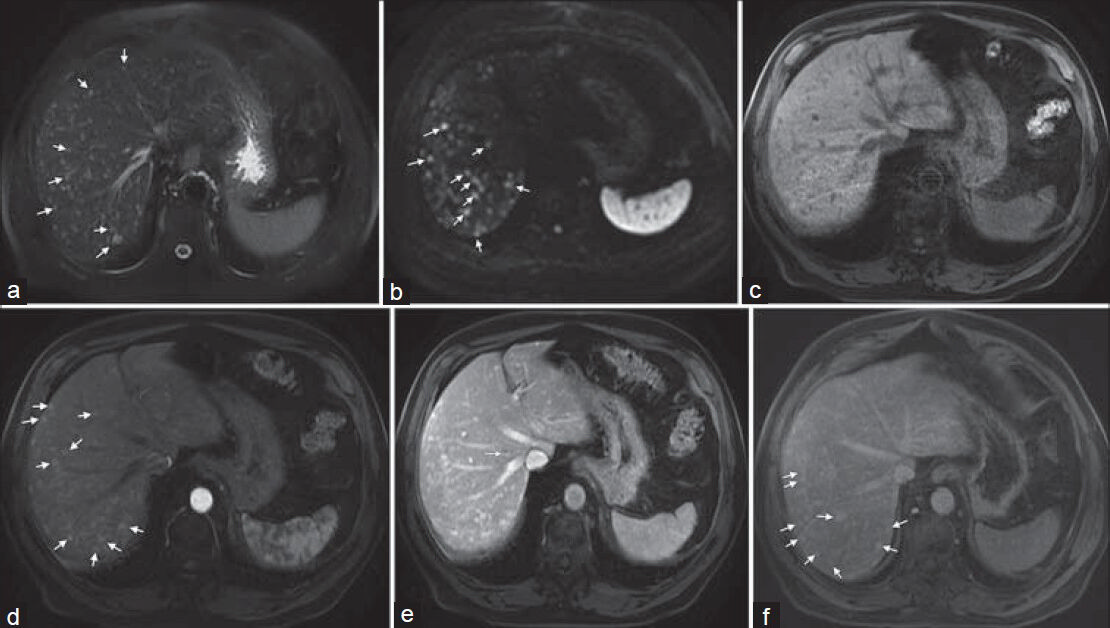 68-year-old male referred to our hospital due to multifocal hepatic lesions, subsequently diagnosed as diffuse hepatic hemangiomatosis. a) Axial fatsaturated T2-weighted image shows countless small-sized moderately bright lesions (arrows). b) Diffusion weighted image shows these lesions with high signal intensity (b = 600 sec/mm2) (arrows), which may be seen in liver hemangiomas secondary to T2 shine-through effect. Axial c) pre-contrast and (d-f) post-contrast fat-saturated T1-weighted images show arterial homogeneous enhancement (arrows, d), some exhibiting portal phase peripheral nodular enhancement (arrow, e) and late centripetal filling (arrows, f).