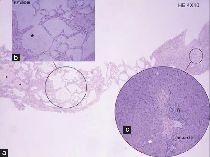 68-year-old male referred to our hospital due to multifocal hepatic lesions, subsequently diagnosed as diffuse hepatic hemangiomatosis. Ultrasound guided biopsy samples stained with hematoxylin and eosin a) 4 × 10, b) 40 × 10; c) 40 × 10). reveal numerous dilated nonanastomotic vascular spaces, which were lined by flat endothelial cells and supported by fibrous tissue endothelium. Some vascular spaces display erythrocyte content (black asterisks, a and b). Chronic inflammatory infiltrates with peri-portal distribution are also present (black outlined asterisk, c). Note the presence of associated macrovesicular steatosis (white asterisk, c).