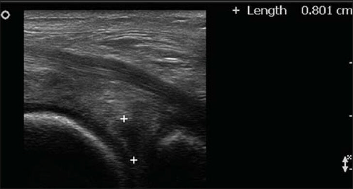 62-year-old male who had pain in the right knee mainly while going down the stairs diagnosed with medial meniscal tear. Ultrasound of the posterior medial part of the knee shows meniscal tear (hypoechoic lesion between plus signs) of the posterior horn of the medial meniscus.