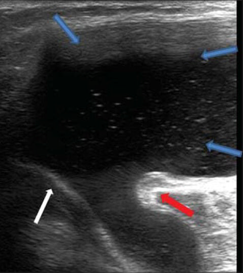 41-year-old man who complained of painful mass in the posterior aspect of the right knee diagnosed as due to Baker's cyst. Ultrasound of the right posterior medial aspect of the knee shows a huge Baker's cyst (between blue arrows) with a connecting neck, lying between the medial gastrocnemius muscle (red arrow) and the semi-membranous tendon (white arrow).