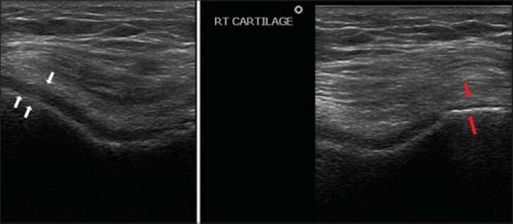 67-year-old female who had right knee pain with difficulty in walking diagnosed with osteoarthritis. Ultrasound of the right knee shows normal thick cartilage at the level of the lateral femoral condyle, hypoechoic, elongated structure (a, white arrows), and loss of cartilage at the medial femoral condyle (b, between red arrows). Such a finding is suggestive of severe osteoarthritis.