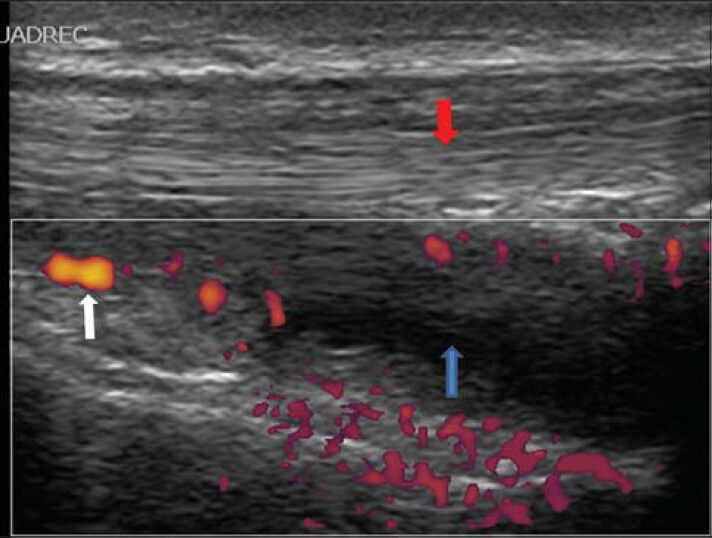 14-year-old male who suffered from painful and limited movement of the right knee diagnosed with knee effusion. Ultrasound power Doppler shows fluid in the suprapatellar bursa (blue arrow) deep to the quadriceps ligament (red arrow) with increased flow (white arrow), a sign of active arthritis.