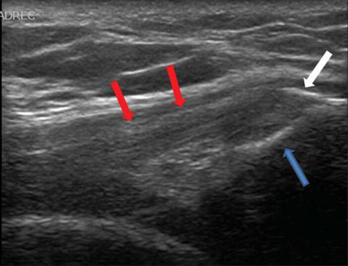 53-year-old lady who suffered from anterior knee pain diagnosed as tendinopathy. Ultrasound of left knee shows tendinopathy with calcifications (white arrow) at the patellar side (blue arrow) of the quadriceps ligament (red arrows).