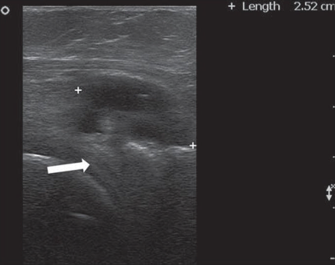 60-year-old lady who suffered from increasing right knee pain while walking diagnosed as due to meniscal cyst. Ultrasound of the posterior aspect of right knee shows cyst (between plus signs) of the posterior lateral meniscal horn (white arrow).