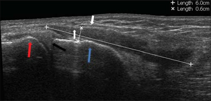 39-year-old man who suffered from pain in the medial aspect of the distal right knee diagnosed with Pes anserine bursitis. Extended panoramic ultrasound view of the medial part of the knee shows fluid in the pes anserinus bursa (asterisks), that was located between the pes anserine ligament (white arrows), medial condyle of the femur (red arrow), medial meniscus (black arrow), and medial distal part of the tibia (blue arrow).