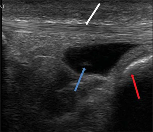 57-year-old male who suffered from pain in the distal portion of the anterior knee diagnosed with infra-patellar bursitis. Ultrasound shows fluid in the infrapatellar bursa (blue arrow) that was confined between the patellar tendon (white arrow) and distally with the anterior tibial tuberosity (red arrow).