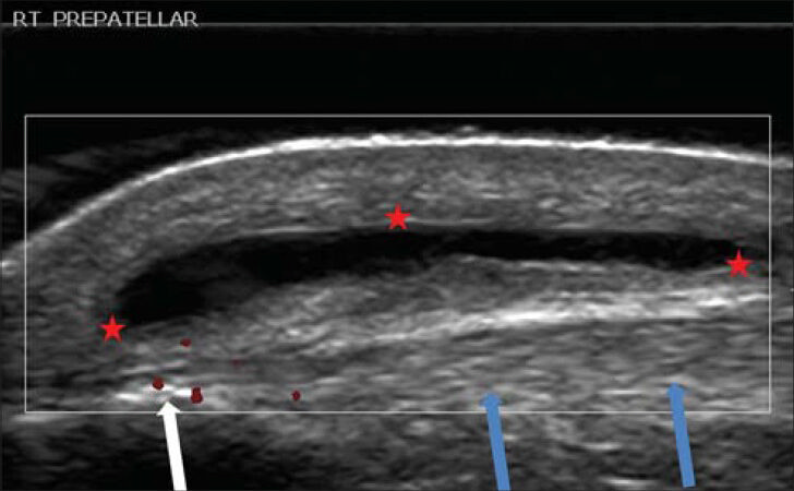 33-year-old female who suffered from painful mass in the anterior part of the right knee diagnosed as having housemaid's knee. Ultrasound of the anterior knee shows prepatellar bursitis (between red asterisks), the so-called housemaid's knee. This bursa was situated superficial to the patellar ligament (blue arrows) and to the patella (white arrow).