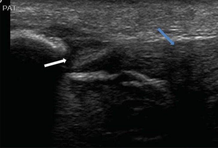 37-year-old female who suffered from limited range of flexion of the knee, associated with pain and swelling of the knee, after falling down with a flexed knee while running. Ultrasound shows partial tear (white arrow) of the patellar tendon (blue arrow).