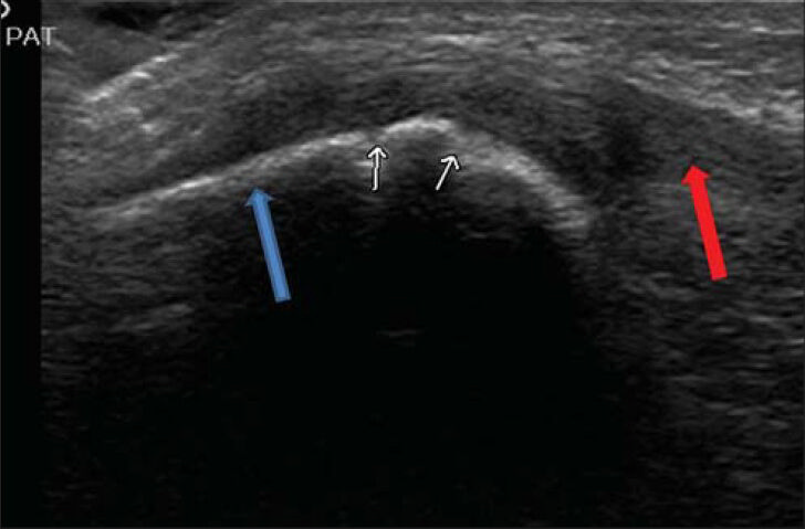 8-year-old girl suffered from pain at the anterior part of the right knee after falling down on a pedestrian walk. X-ray of the patella revealed no pathology. Ultrasound of knee shows avulsion fracture (white small arrows) of the anterior part of the patella (blue arrow) with partial tear of the proximal section of the patellar tendon (red arrow).