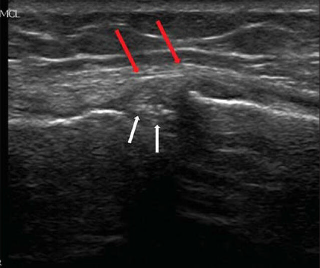 74-year-old female who suffered from knee pain daily while walking diagnosed as due to presence of calcium pyrophosphate dehydrate crystals. Ultrasound of the right knee shows punctuate calcification “hyperechoic foci” in the medial meniscus (white arrows) that was medially located to the medial collateral ligament (red arrows).