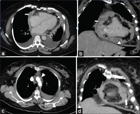 A Rare Case of Primary Malignant Pericardial Mesothelioma - Journal of