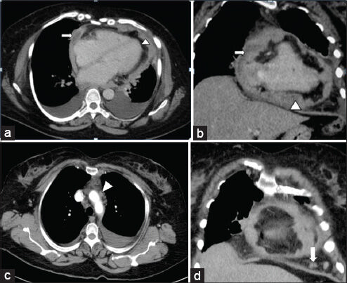 55-year-old woman with breathing difficulty diagnosed with primary malignant pericardial mesothelioma. (a and b) Contrast-enhanced axial reformatted CT images of the thorax show lobulated thickening of the pericardium (arrow head) and fluid collections within the pericardial sleeves (arrow). (c and d) Contrast-enhanced coronal reformatted CT images of the thorax show enlarged prevascular (arrow head) and pericardial lymph nodes (arrow).