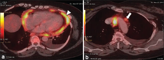 55-year-old woman with breathing difficulty diagnosed with primary malignant pericardial mesothelioma. (a and b) FDG-PET/CT axial images show metabolically active uptake in the pericardial thickening (arrow head) and in the mediastinal lymph node (arrow).