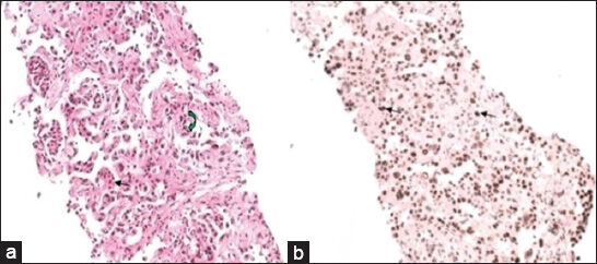 55-year-old woman with breathing difficulty diagnosed with primary malignant pericardial mesothelioma. a) Photomicrograph of hematoxylin and eosin (×200) stained biopsy sample of the pericardium shows tumor cells forming glands (black arrow) and occasional papillary process (green arrow). b) Immunohistochemistry analysis (×200) of the biopsy tissue shows tumor cells with nuclear positivity for Wilm's Tumor 1 (WT1) marker (black arrow).