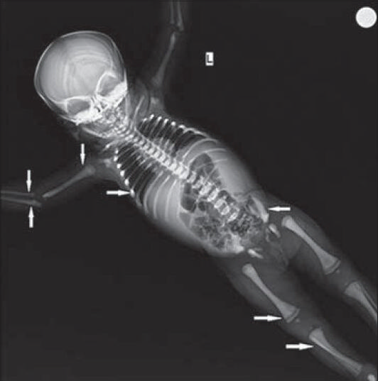 45-dayold infant presented with splenohepatomegaly, which was subsequently diagnosed as malignant infantile osteopetrosis. X-ray of the skeleton shows (solid arrow) bone in bone appearance in the femur, tibia, humerus, radius, ulna, and iliac bones.