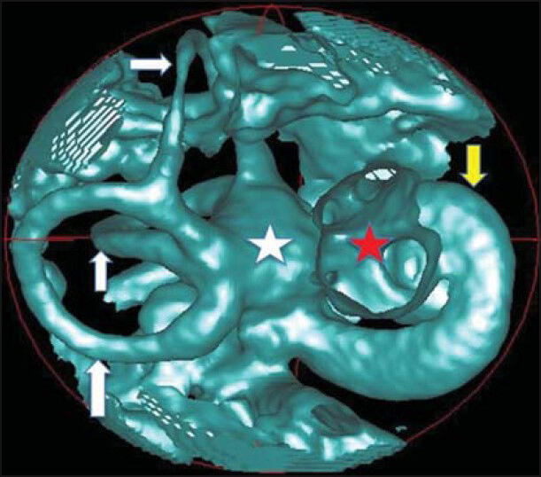 60-year-old female patient with clinical history of hearing loss diagnosed with sensorineural hearing loss. CBCT of temporal bone three-dimensional image with air cavity volume rendering (green), shows normal inner ear: Semicircular canals (white arrows), vestibule (white star), cochlea (yellow arrow) and internal auditory canal (red star).