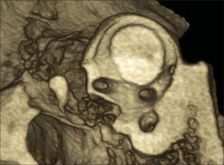 28-year-old male patient with clinical history of bilateral hearing loss and semicircular canal dehiscence diagnosed with conductive hearing loss due to bilateral fixing of the malleus. Bilateral CBCT of temporal bone three-dimensional image with osseous volume rendering demonstrates normal superior semicircular canal.